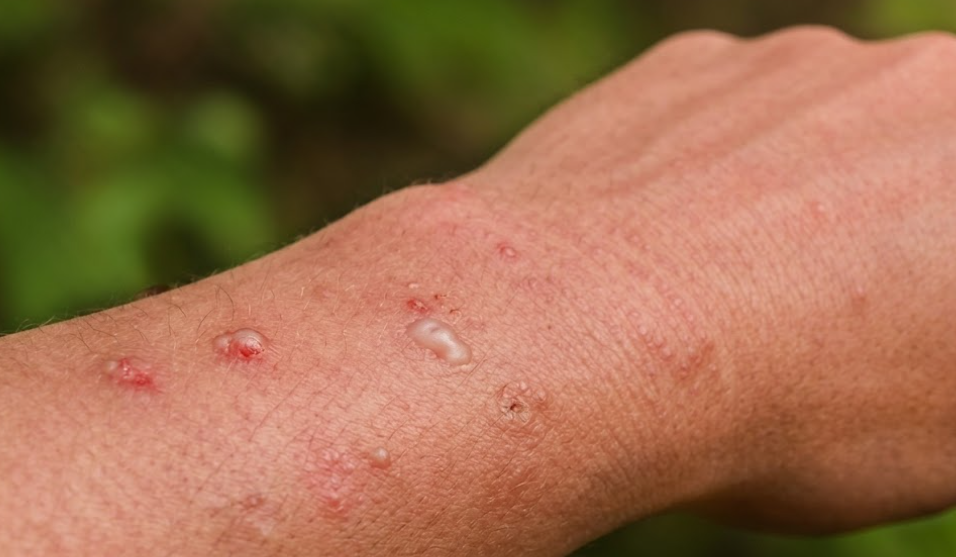 Mosquito bites
